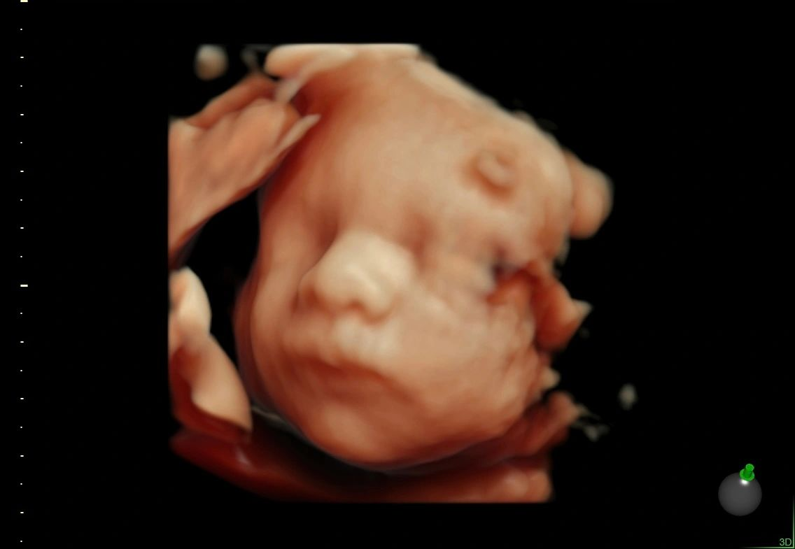 4D ultrasound portrait showing a baby's tiny facial features