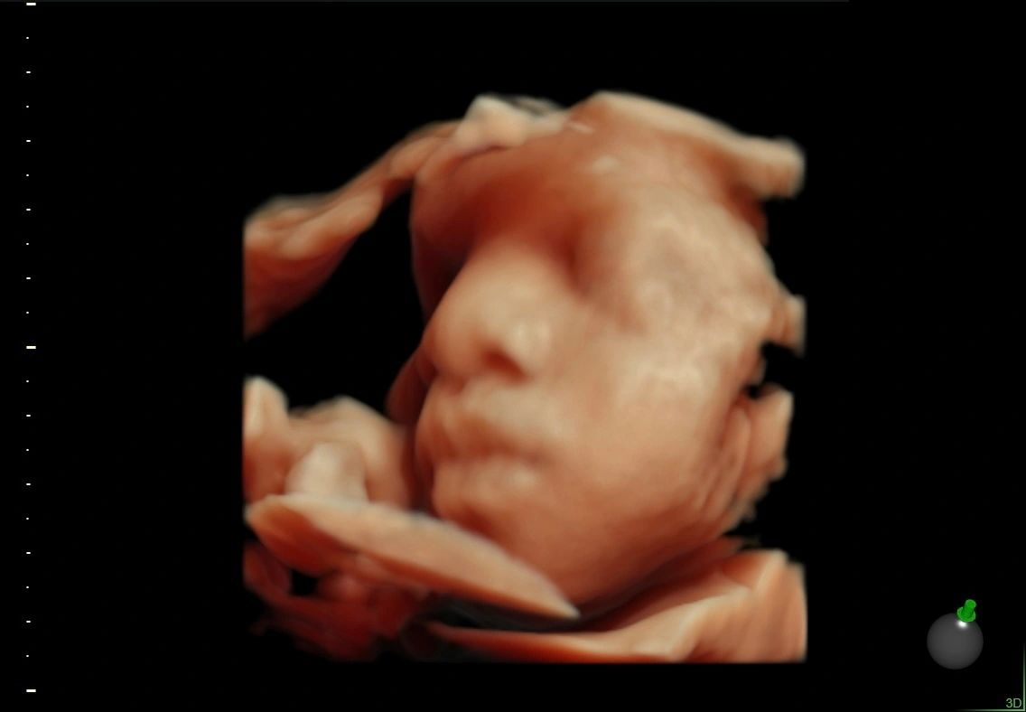 4D ultrasound view of a baby's face and hand