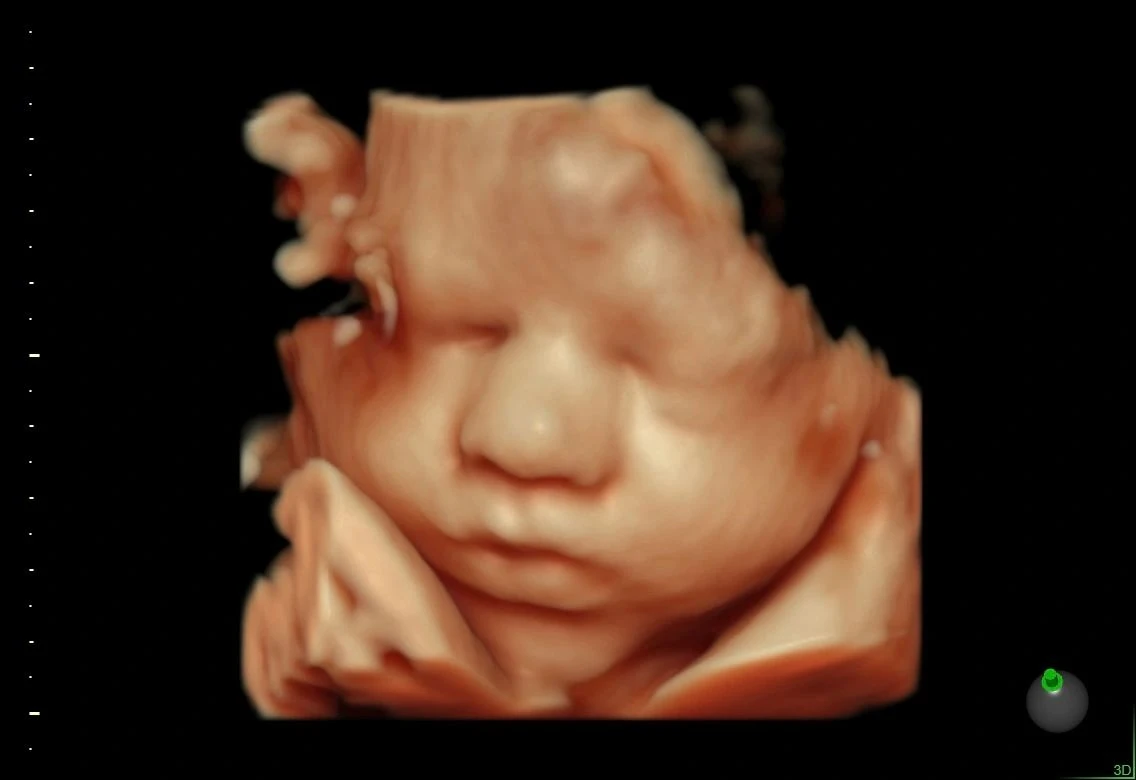 HDLive ultrasound showing a baby's face with a hand beside the cheek