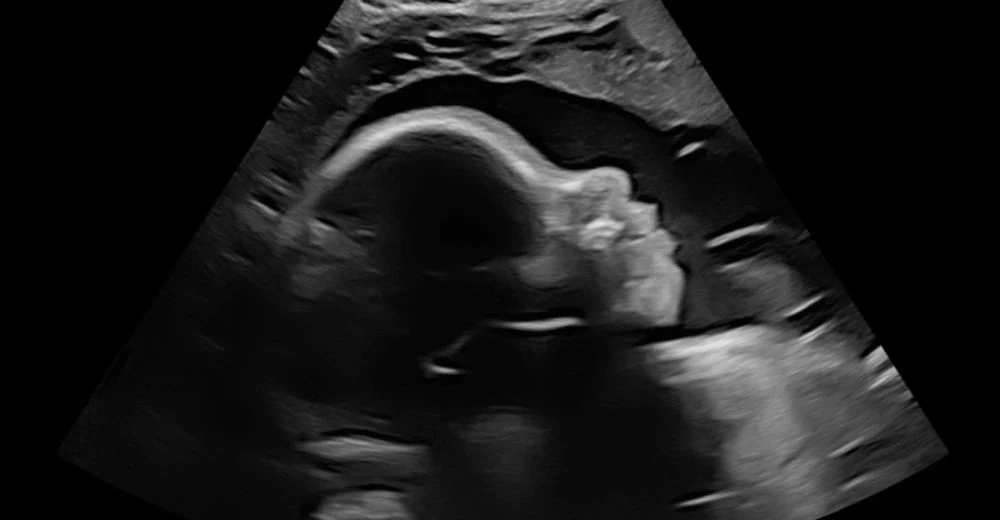 2D ultrasound showing a baby's profile at 4D Sneak Peek