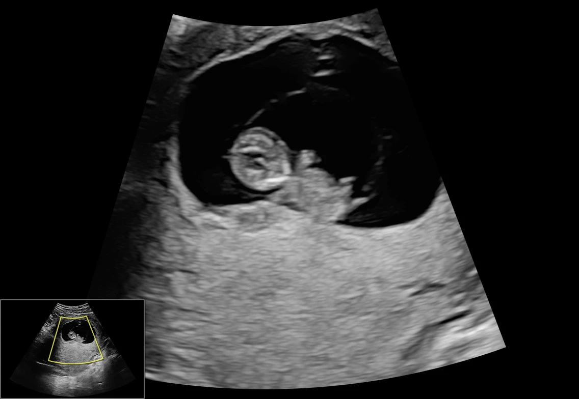 Black-and-white 2D ultrasound showing an early glimpse of a baby.